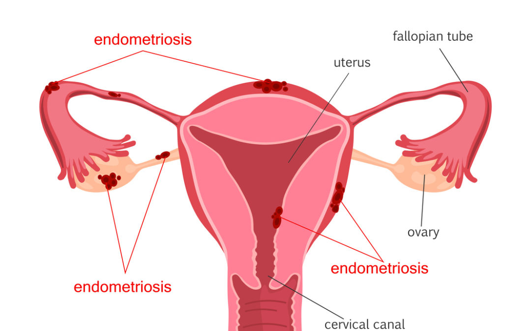 Endometriosis diagram. Diseases of the female reproductive system.