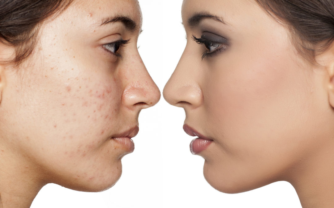 Acne and Pimples – Finding relief with the right Diet and Chinese Medicine
